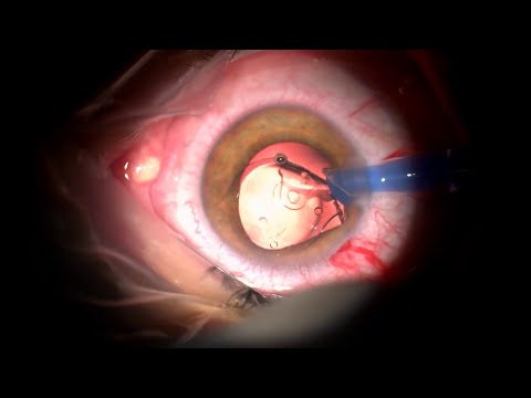 #014 Phakic multifocal IOL in high myopia